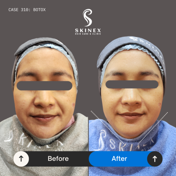 Case 310 Botox