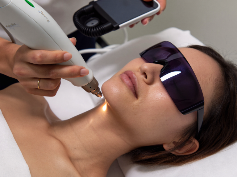 Indonesian woman without hijab receiving pico laser treatment at Skinex clinic
