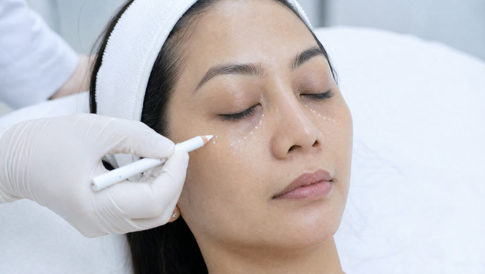 Dokter menandai area tear trough di bawah mata pasien sebelum treatment skin booster untuk mata panda