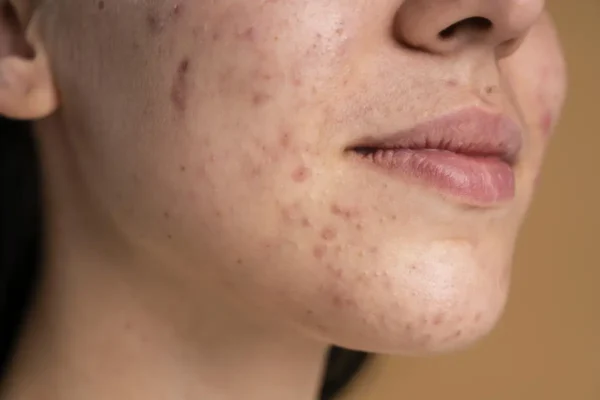 skin barrier